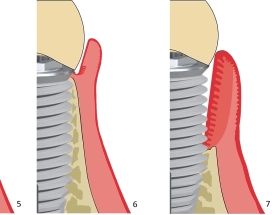 Implantaten reinigen