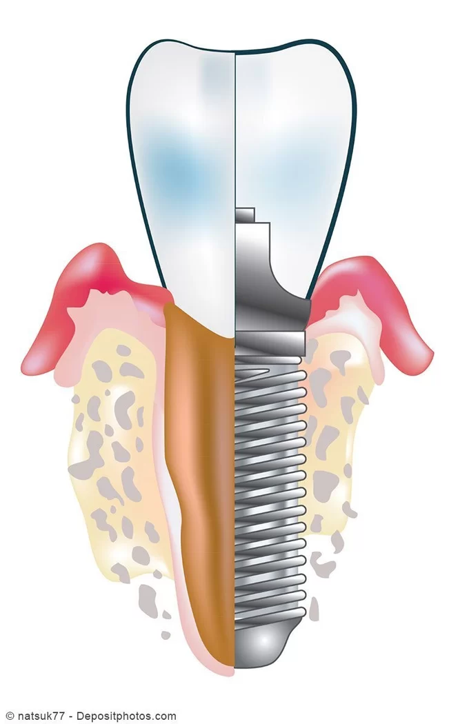 Implantaten reinigen