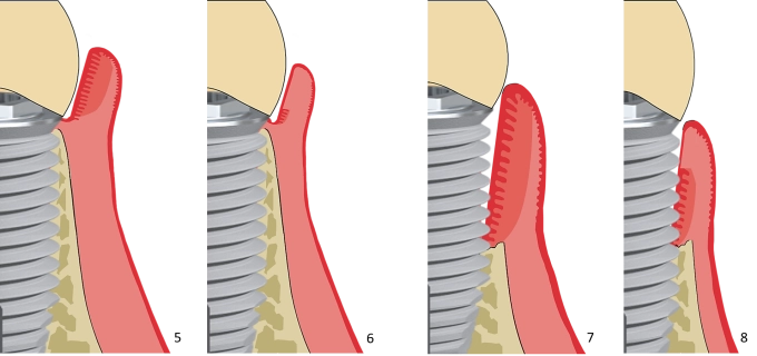 Implantaten reinigen