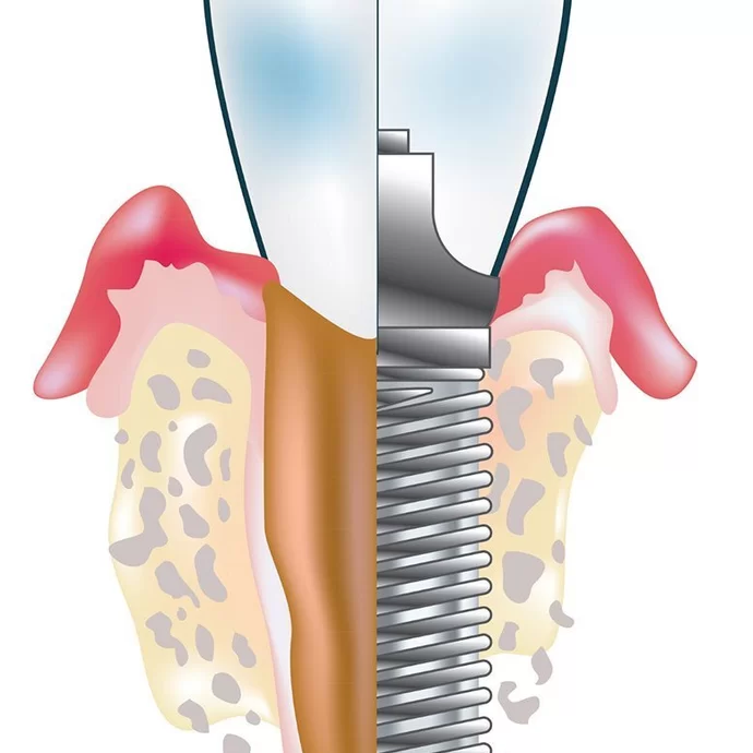 Implantaten reinigen