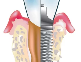 Implantaten reinigen