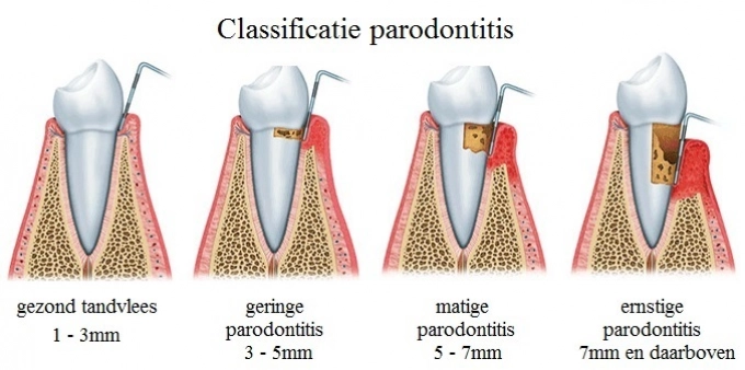 Parodontitis